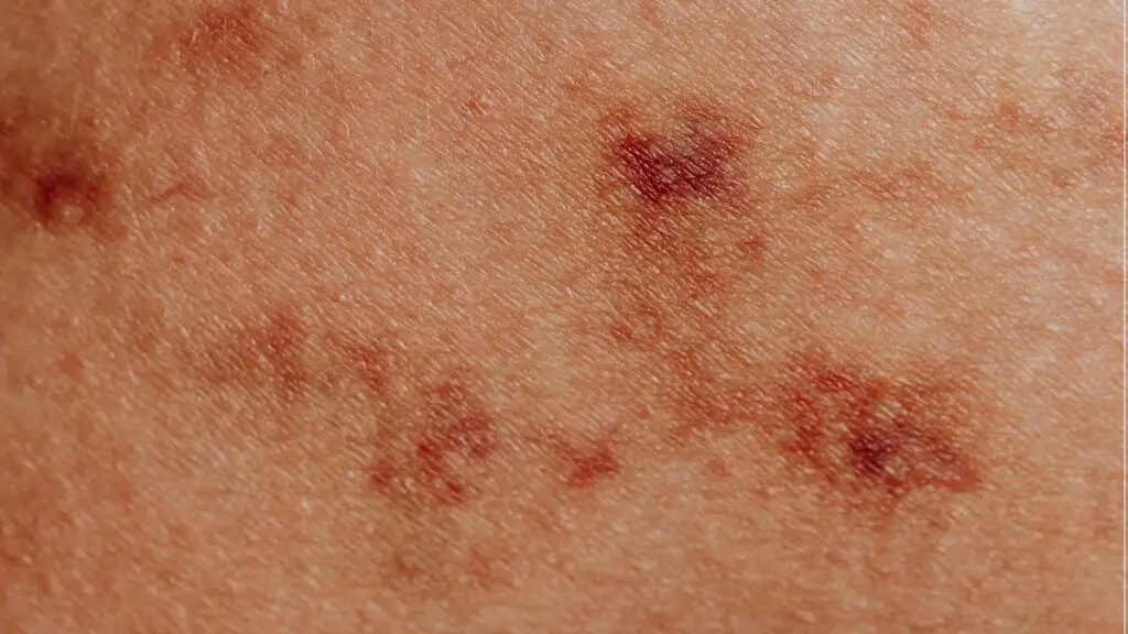 What Does Tomato Plant Rash Look Like?